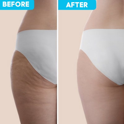 CelluRevive™ Ultra-Firming Cellulite Remover