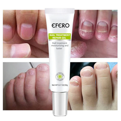 Belle Flores Beauty™ Anti-Fungal Nail Repair Gel | Buy 1 Get 1 FREE